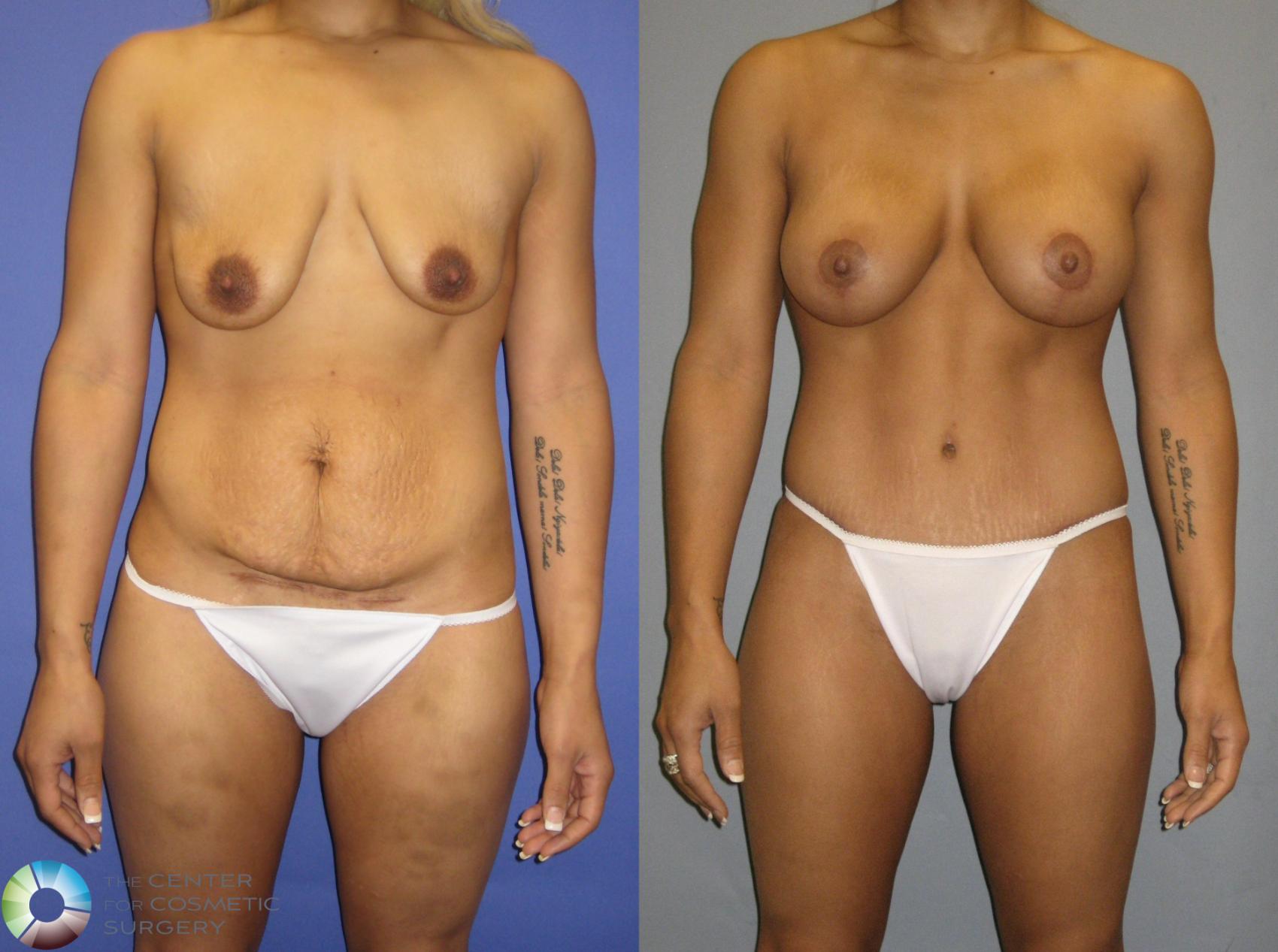 Before & After Tummy Tuck Case 325 View #1 in Denver and Colorado Springs, CO