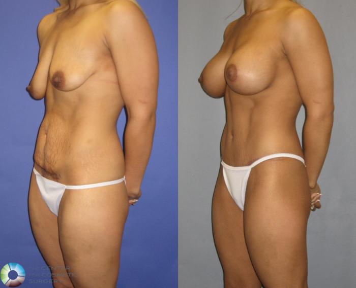 Before & After Breast Lift Case 325 View #2 View in Golden, CO