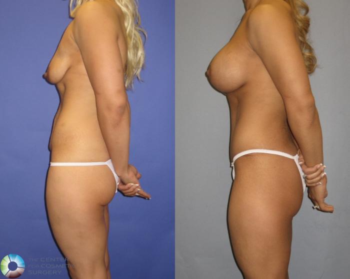 Before & After Breast Augmentation Case 325 View #3 View in Golden, CO
