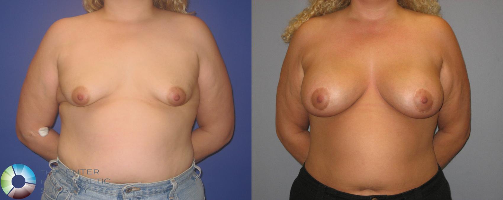 Before & After Breast Augmentation Case 330 View #1 in Denver and Colorado Springs, CO