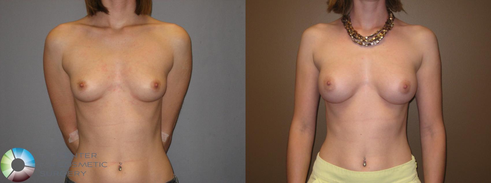 Before & After Breast Augmentation Case 331 View #1 View in Denver & Golden, CO