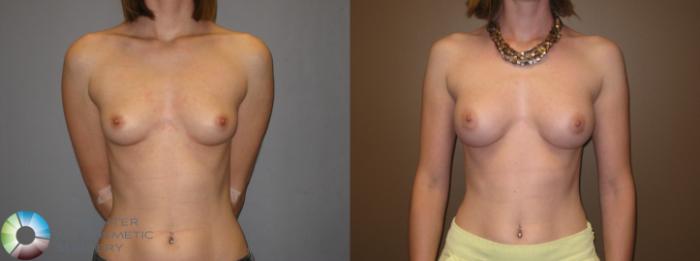 Before & After Breast Augmentation Case 331 View #1 in Denver and Colorado Springs, CO