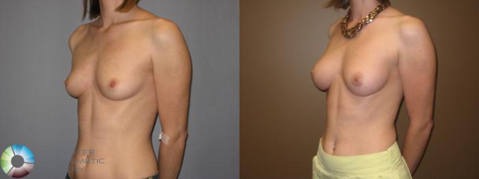 Before & After Breast Augmentation Case 331 View #2 in Denver and Colorado Springs, CO