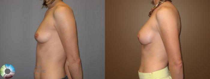 Before & After Breast Augmentation Case 331 View #3 in Denver and Colorado Springs, CO