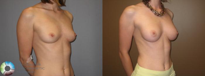 Before & After Breast Augmentation Case 331 View #4 in Denver and Colorado Springs, CO
