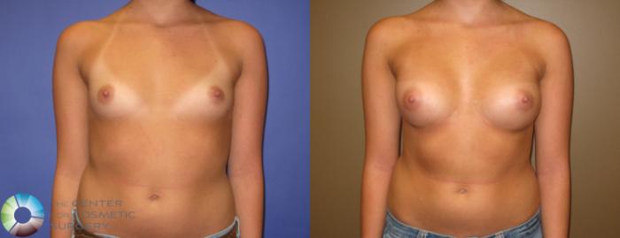 Before & After Breast Augmentation Case 332 View #1 in Denver and Colorado Springs, CO