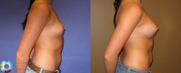 Before & After Breast Augmentation Case 332 View #2 in Denver and Colorado Springs, CO