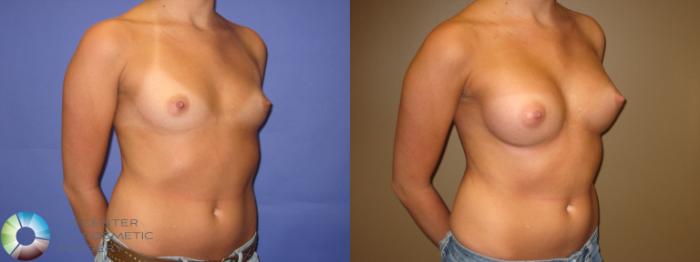 Before & After Breast Augmentation Case 332 View #3 in Denver and Colorado Springs, CO
