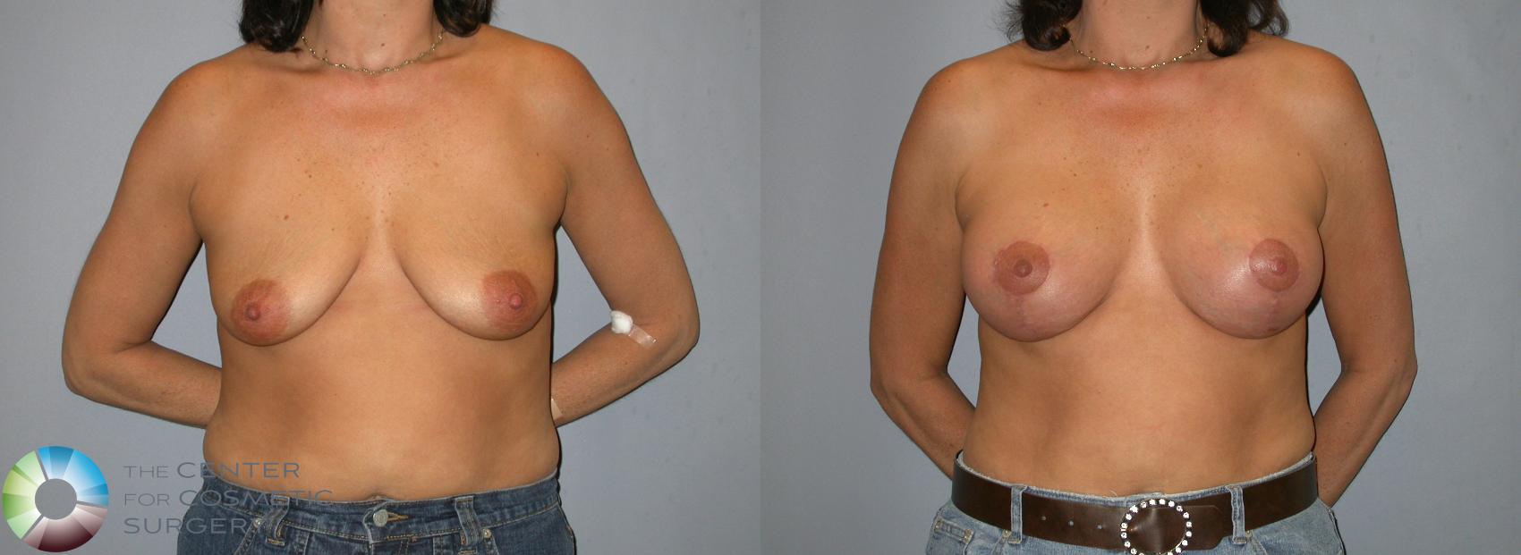 Before & After Breast Augmentation Case 345 View #1 in Denver and Colorado Springs, CO