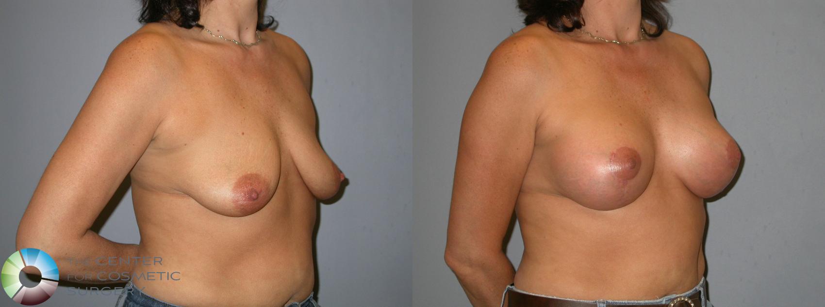 Before & After Breast Augmentation Case 345 View #2 in Denver and Colorado Springs, CO