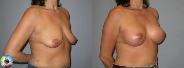 Before & After Breast Lift Case 345 View #2 View in Golden, CO