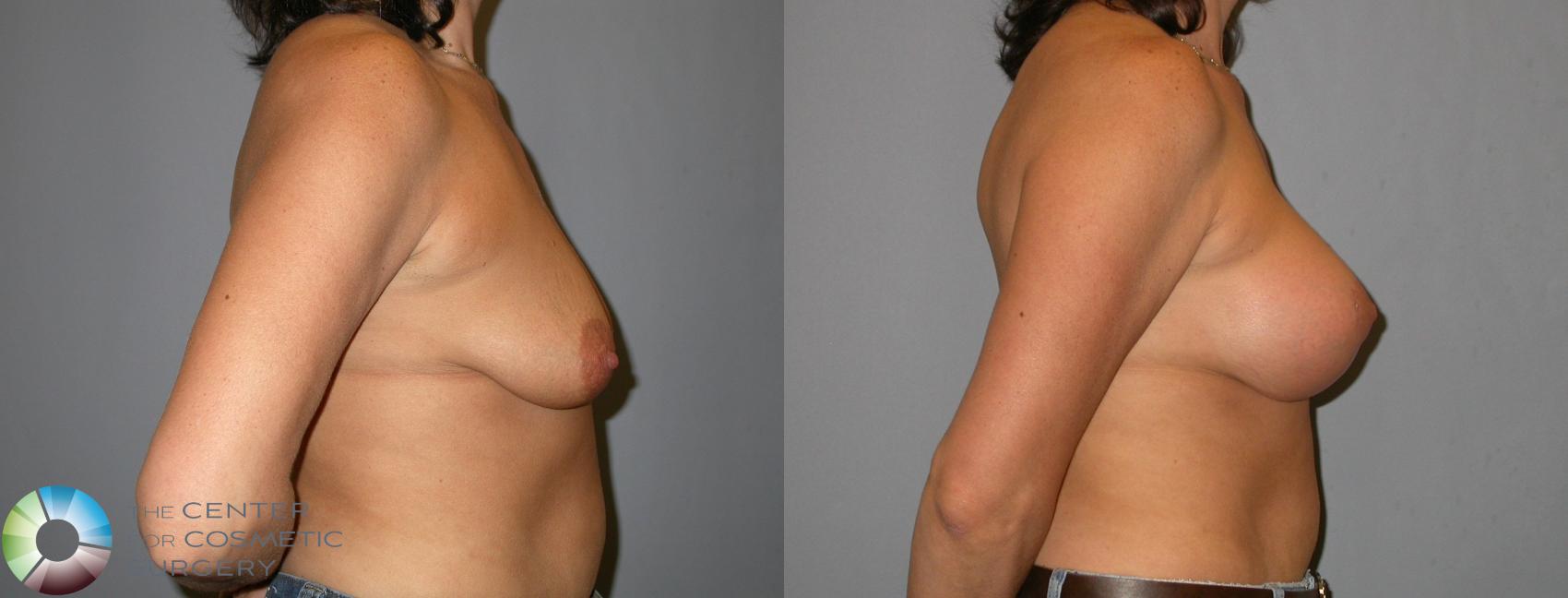 Before & After Breast Augmentation Case 345 View #3 in Denver and Colorado Springs, CO