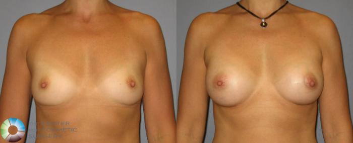 Before & After Breast Augmentation Case 351 View #1 in Denver and Colorado Springs, CO