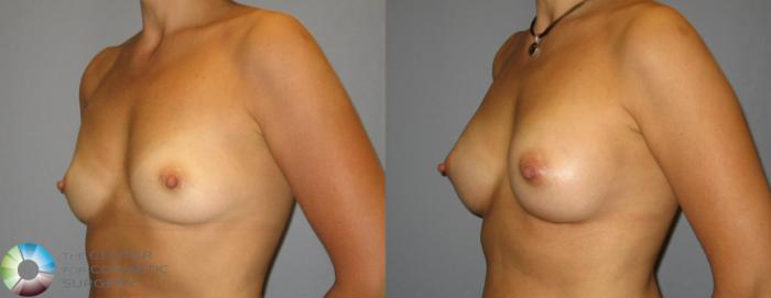 Before & After Breast Augmentation Case 351 View #2 in Denver and Colorado Springs, CO