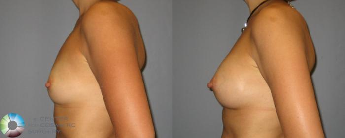 Before & After Breast Augmentation Case 351 View #3 in Denver and Colorado Springs, CO