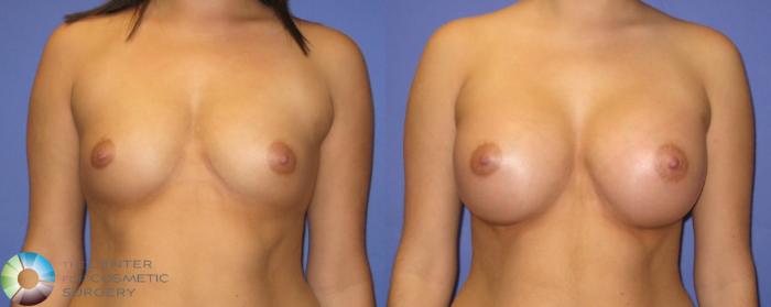 Before & After Breast Augmentation Case 352 View #1 in Denver and Colorado Springs, CO