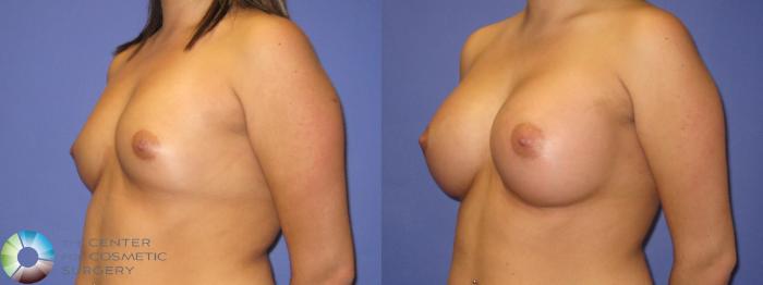 Before & After Breast Augmentation Case 352 View #2 in Denver and Colorado Springs, CO