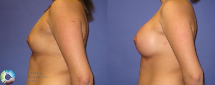Before & After Breast Augmentation Case 352 View #3 in Denver and Colorado Springs, CO