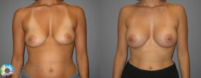 Before & After Breast Augmentation Case 353 View #1 in Denver and Colorado Springs, CO