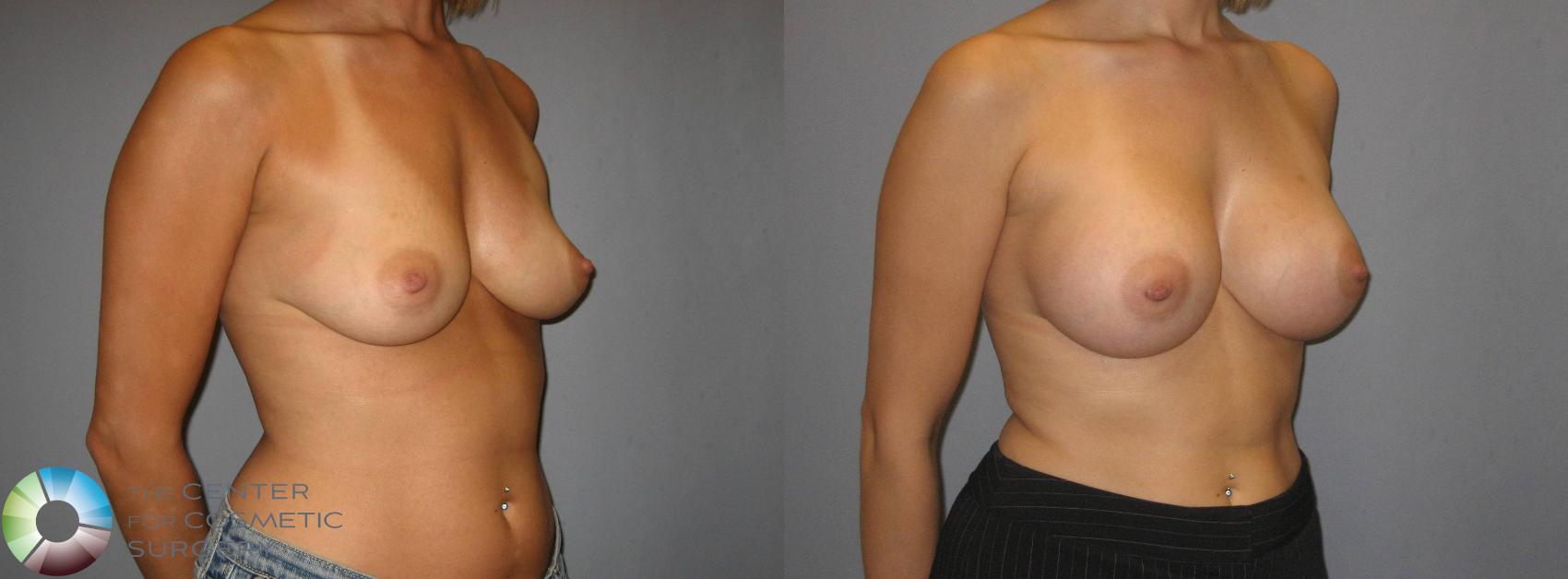 Before & After Breast Augmentation Case 353 View #2 View in Golden, CO