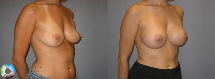 Before & After Breast Augmentation Case 353 View #2 in Denver and Colorado Springs, CO
