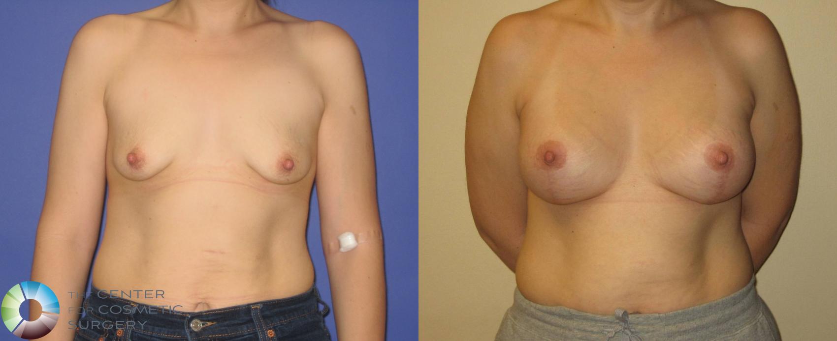 Before & After Breast Augmentation Case 355 View #1 in Denver and Colorado Springs, CO