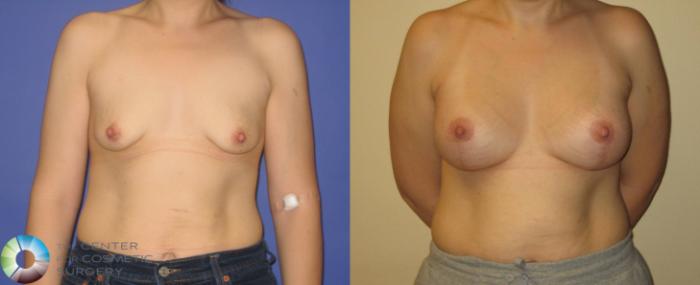 Before & After Breast Augmentation Case 355 View #1 View in Golden, CO