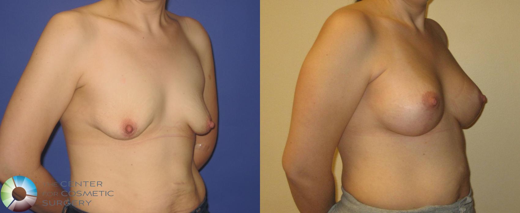 Before & After Breast Augmentation Case 355 View #2 in Denver and Colorado Springs, CO