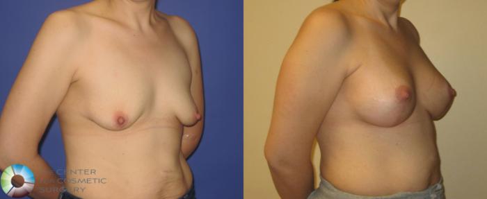 Before & After Breast Augmentation Case 355 View #2 View in Golden, CO
