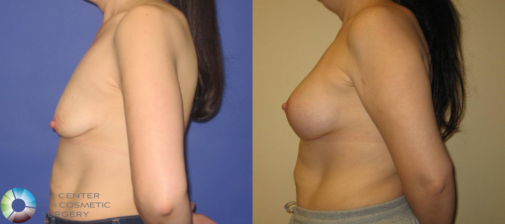 Before & After Breast Augmentation Case 355 View #3 in Denver and Colorado Springs, CO