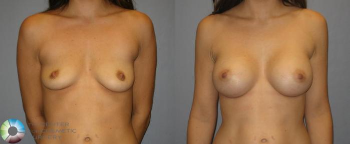 Before & After Breast Augmentation Case 357 View #1 in Denver and Colorado Springs, CO