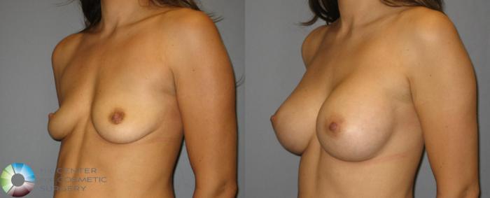 Before & After Breast Augmentation Case 357 View #2 in Denver and Colorado Springs, CO