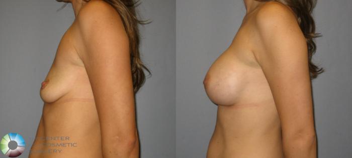Before & After Breast Augmentation Case 357 View #3 in Denver and Colorado Springs, CO