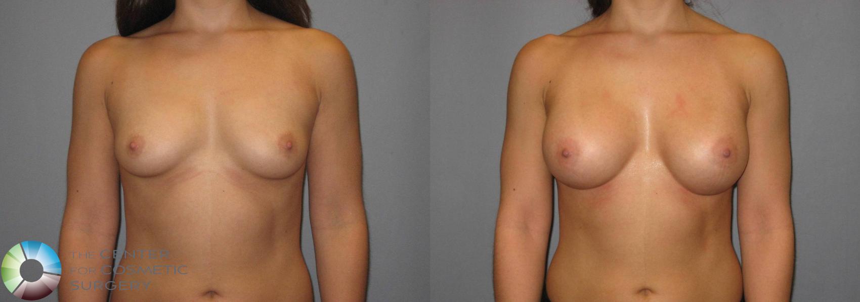 Before & After Breast Augmentation Case 359 View #1 in Denver, CO