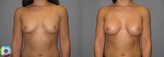Before & After Breast Augmentation Case 359 View #1 View in Golden, CO