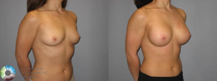 Before & After Breast Augmentation Case 359 View #2 View in Golden, CO