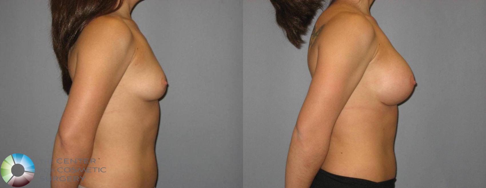 Before & After Breast Augmentation Case 359 View #3 View in Golden, CO
