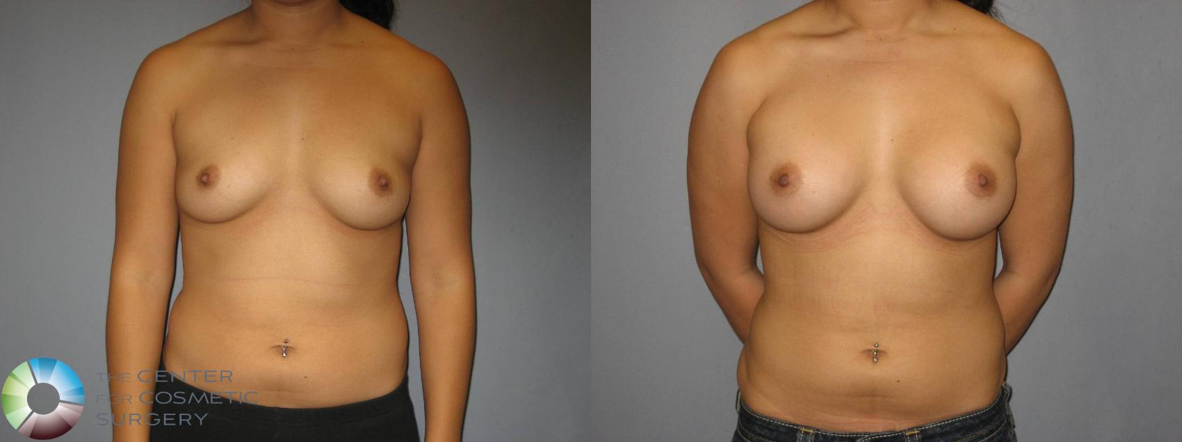 Before & After Breast Augmentation Case 360 View #1 in Denver and Colorado Springs, CO