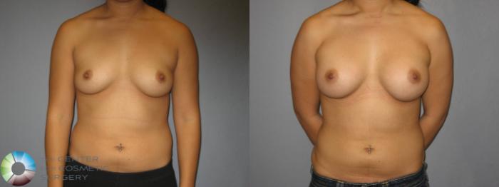 Before & After Breast Augmentation Case 360 View #1 View in Golden, CO
