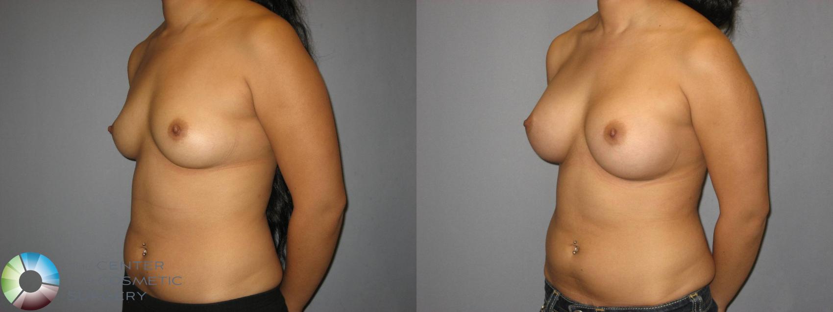 Before & After Breast Augmentation Case 360 View #2 in Denver and Colorado Springs, CO