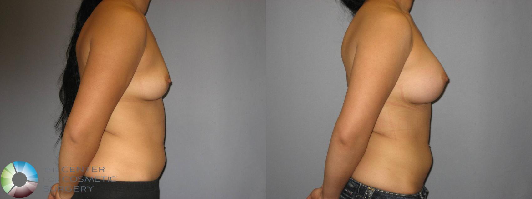 Before & After Breast Augmentation Case 360 View #3 in Denver and Colorado Springs, CO