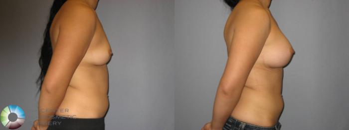 Before & After Breast Augmentation Case 360 View #3 View in Golden, CO