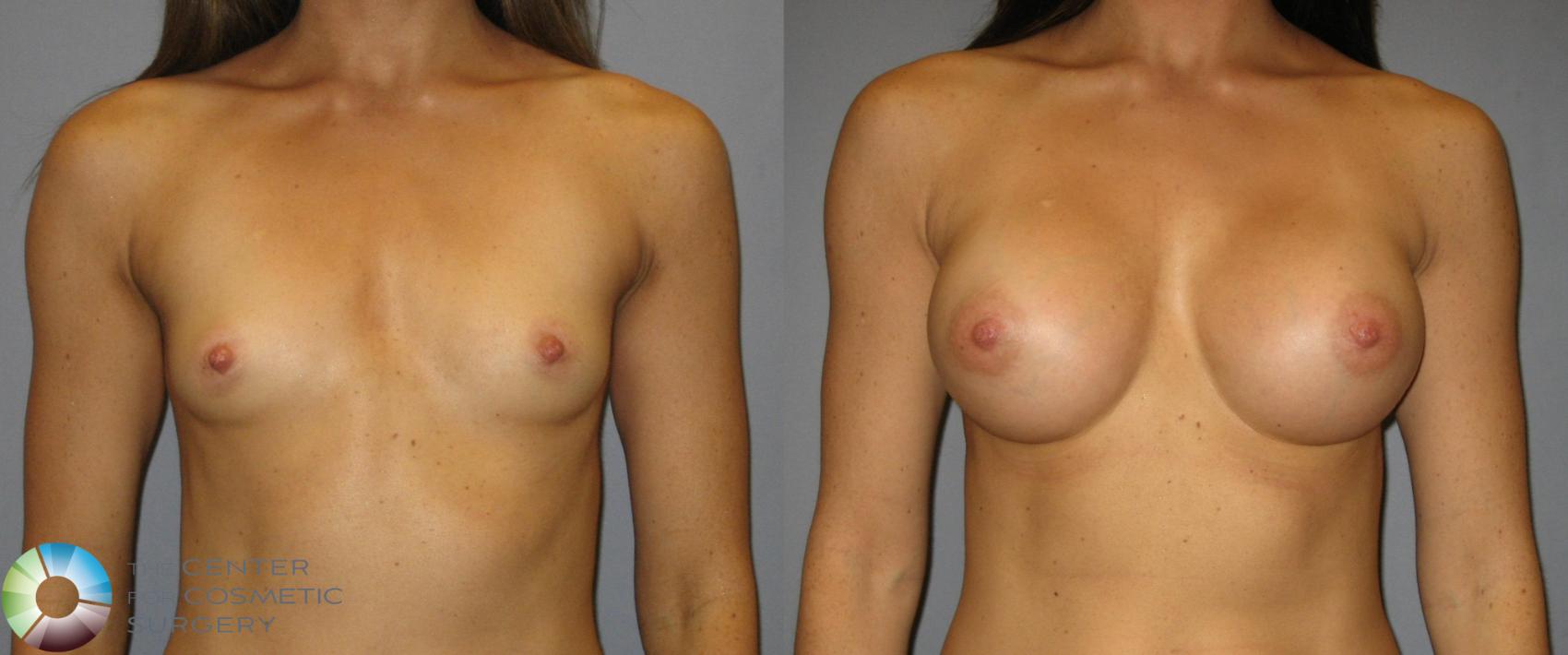 Before & After Breast Augmentation Case 361 View #1 in Denver and Colorado Springs, CO