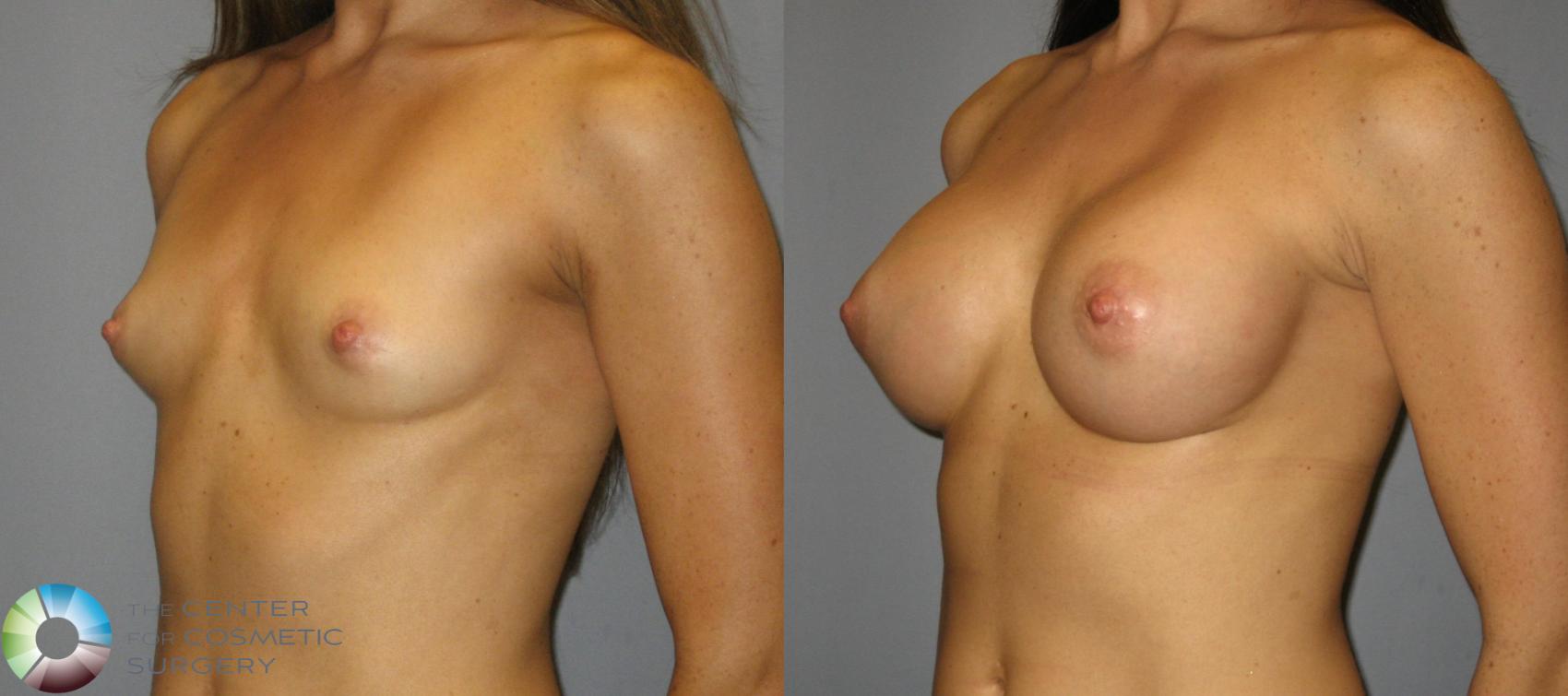 Before & After Breast Augmentation Case 361 View #2 View in Golden, CO