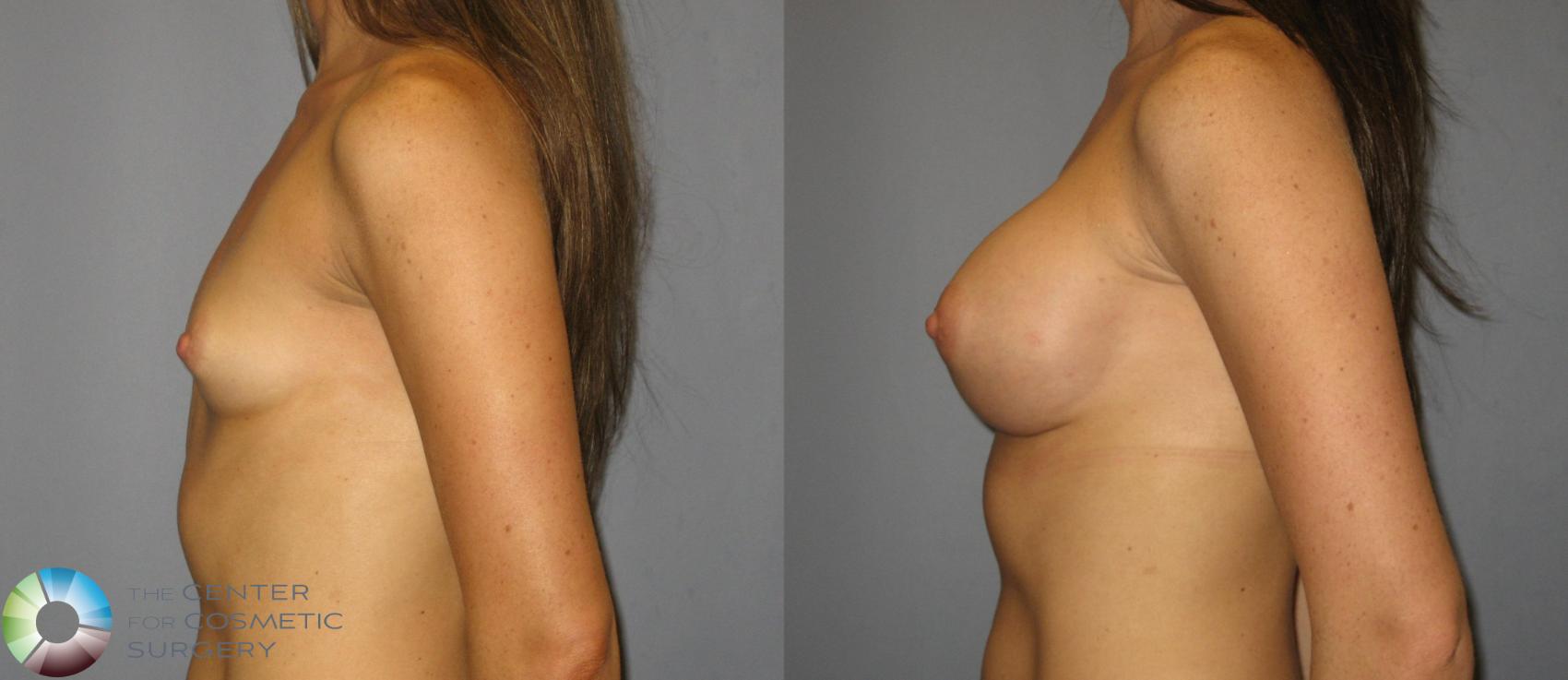 Before & After Breast Augmentation Case 361 View #3 View in Golden, CO