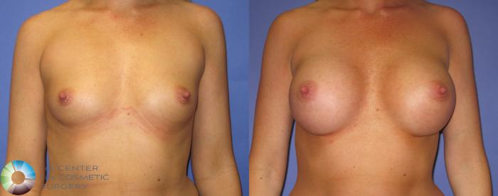 Before & After Breast Augmentation Case 368 View #1 in Denver and Colorado Springs, CO