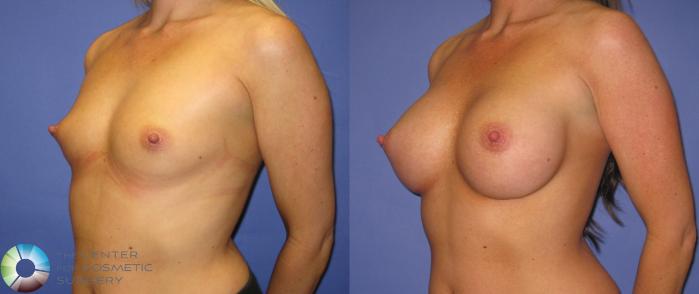 Before & After Breast Augmentation Case 368 View #2 in Denver and Colorado Springs, CO