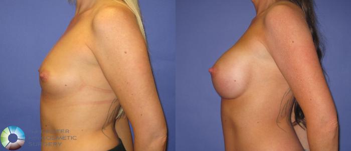 Before & After Breast Augmentation Case 368 View #3 in Denver and Colorado Springs, CO