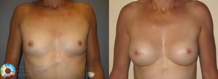 Before & After Breast Augmentation Case 369 View #1 in Denver and Colorado Springs, CO