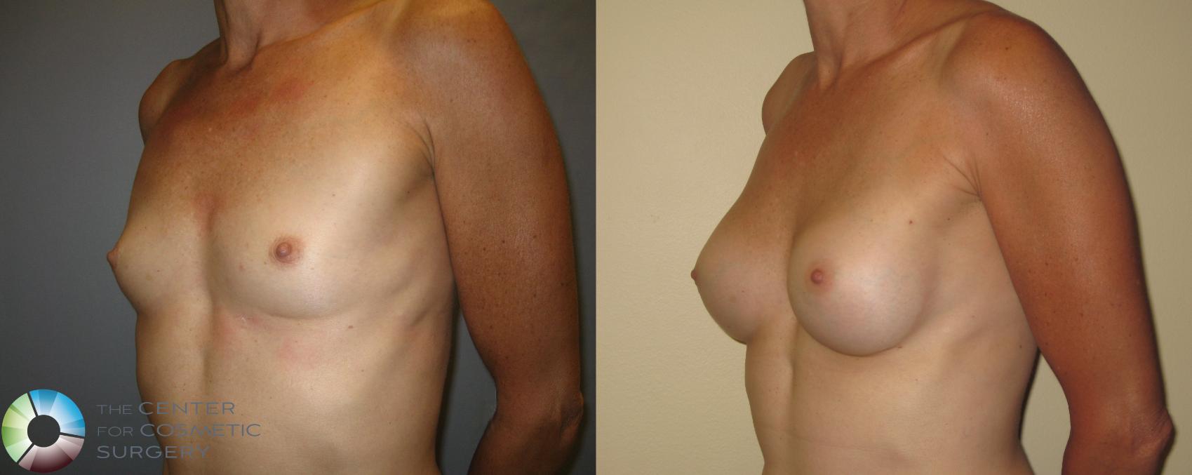 Before & After Breast Augmentation Case 369 View #2 View in Golden, CO